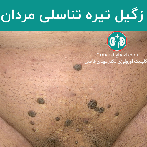 تصویر تعدادی زگیل تیره و بزرگ در ناحیه تناسلی مردانه