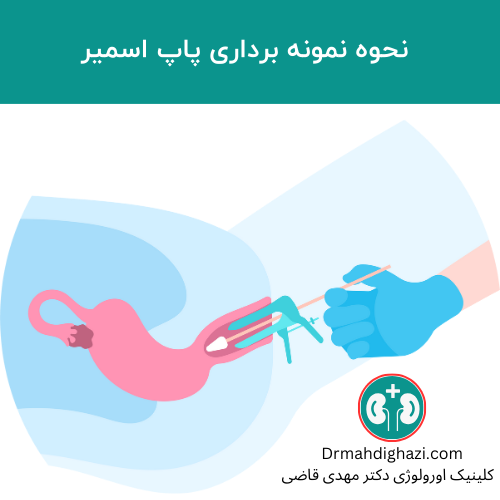 نحوه نمونه برداری از ضایعات مشکوک درون واژن جهت پاپ اسمیر