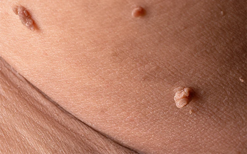 آگاهی از روشهای انتقال زگیل تناسلی و ویروس HPV؛ لازمه پیشگیری